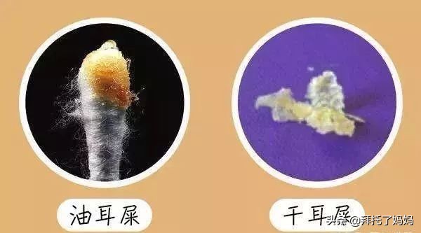 小孩长期不挖耳屎的危害,男童4年没有挖耳屎