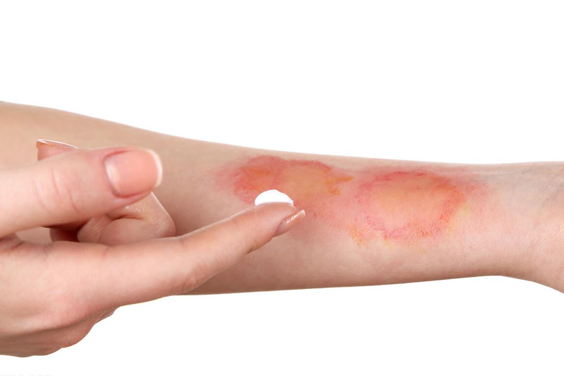 “黑科技发热卫生巾”被投诉烫伤，跟个人体质有关？