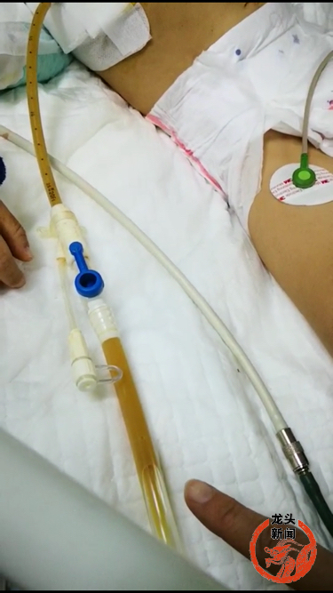 两岁宝宝发烧不退是甲流吗,孩子拍片疑似右肺炎症