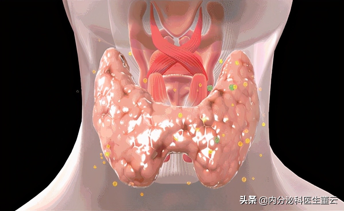 总是犯困越睡越想睡是甲减吗,每天犯困眼睛很疲倦是不是得甲减