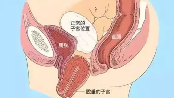 失恋后，她的子宫竟然“掉”出来了