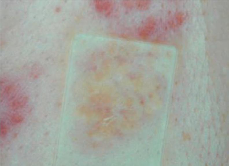 结节病关节痛眼睛模糊,结节病引起的关节炎