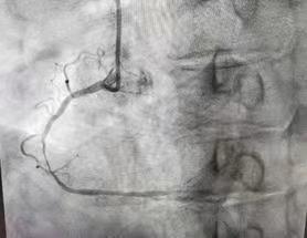 陕西冠脉介入手术,冠脉支架降价最新价格