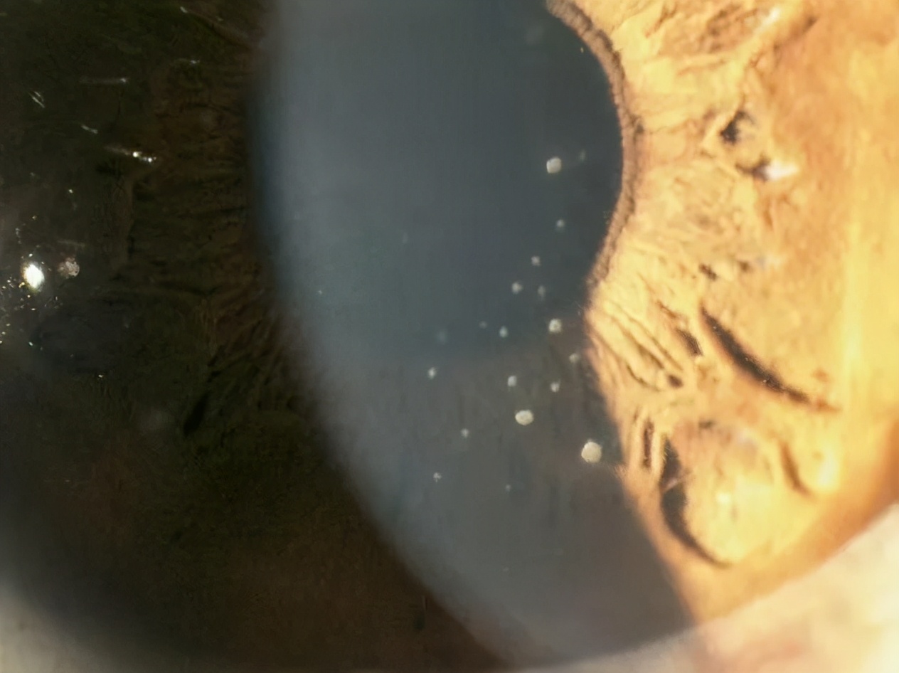 长期熬夜导致眼睛视线模糊怎么办,连续熬夜眼睛模糊失明