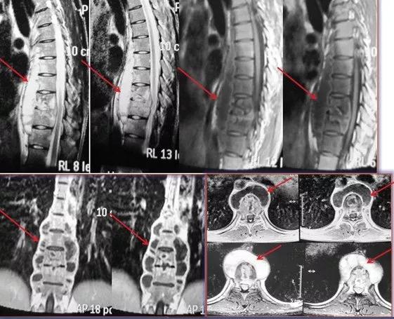 脊柱结核保守治疗大约需要多少钱,脊柱结核可以保守治疗