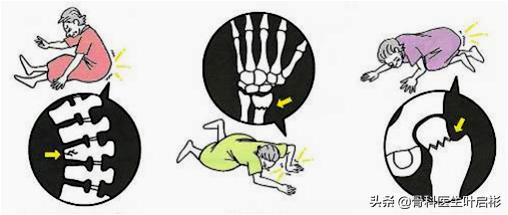 中老年男性常见的骨折,中老年人容易骨折怎么办