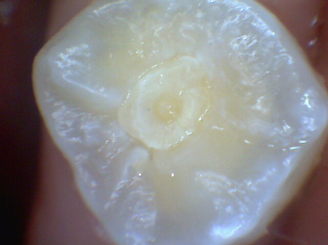 做根管治疗为什么不能做到一半,做根管治疗一定要问的问题