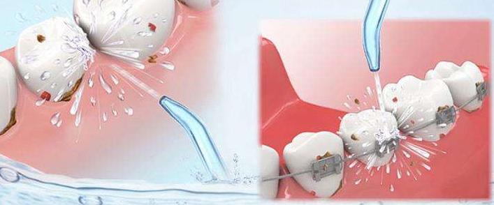 洗牙去除异物吗,洗牙怎样才不伤牙齿