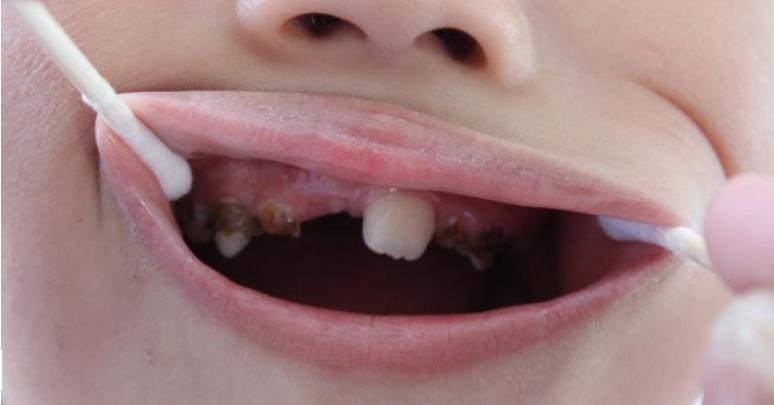 儿童大牙龋齿严重该怎么办,儿童牙有龋齿应该怎么治疗
