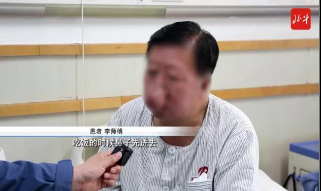 男子喝40年的酒鼻子长到下巴,男子喝了四十年的酒