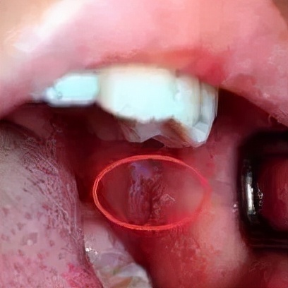 疱疹性咽峡炎进入高发期,如何防治看这里