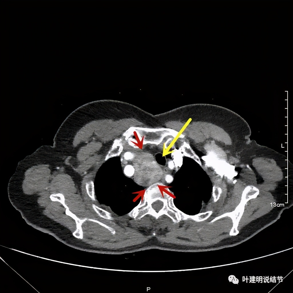 胸部高分辨ct检查注意事项,胸部ct扫描有没有危害