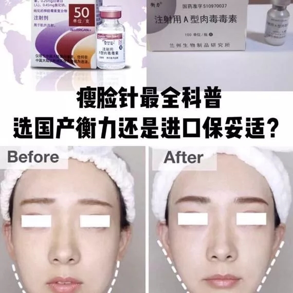 星肉瘦脸针进口与国产哪个便宜,国产瘦脸针跟进口什么区别