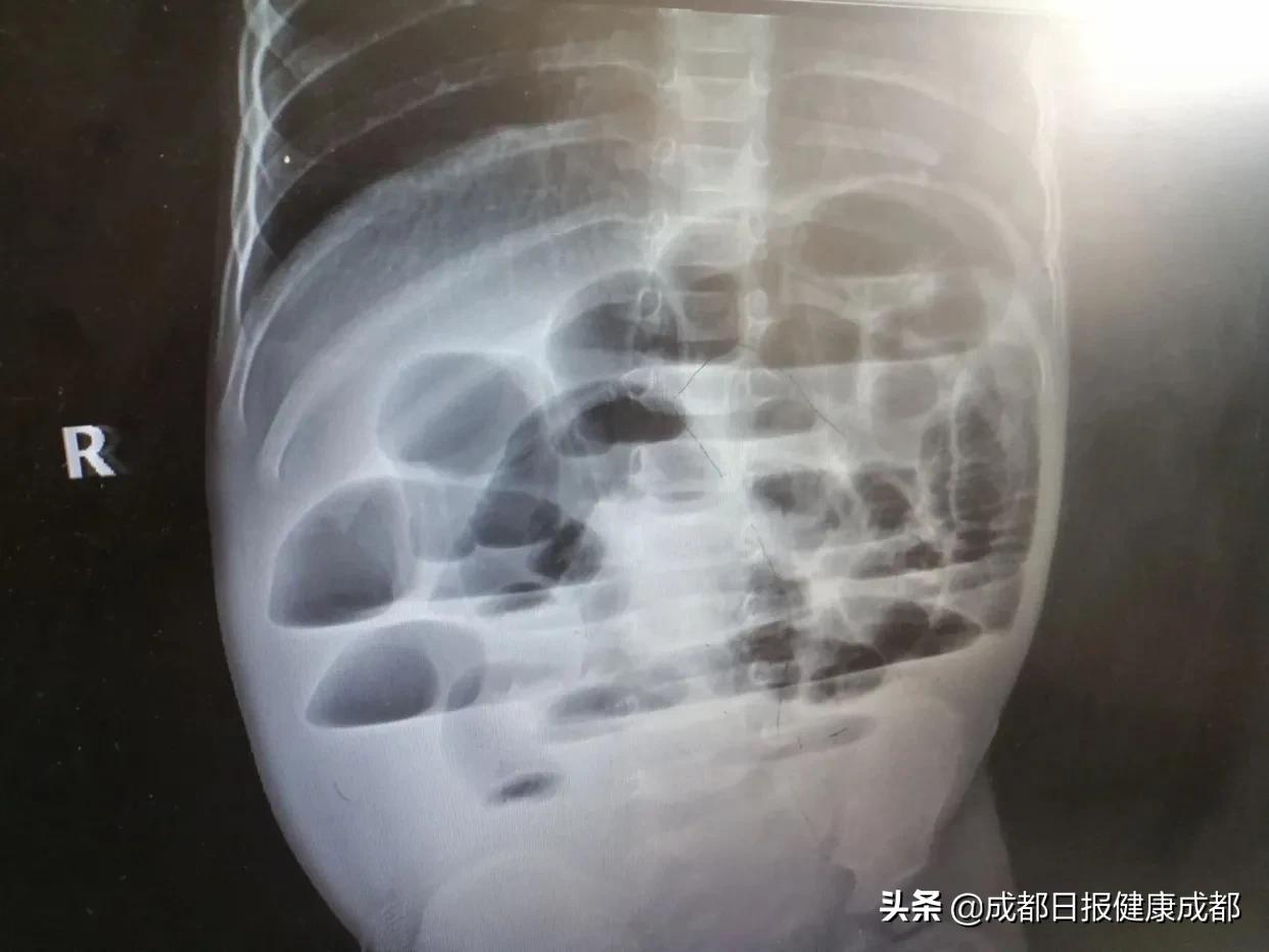 这个病拖了12小时险些让1岁宝宝丧命