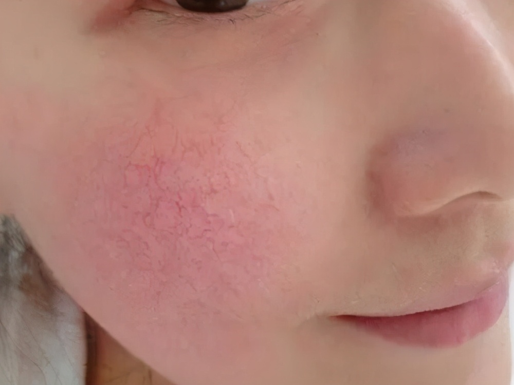 脸部红血丝怎么去除有效,脸部红血丝该怎样祛除呢
