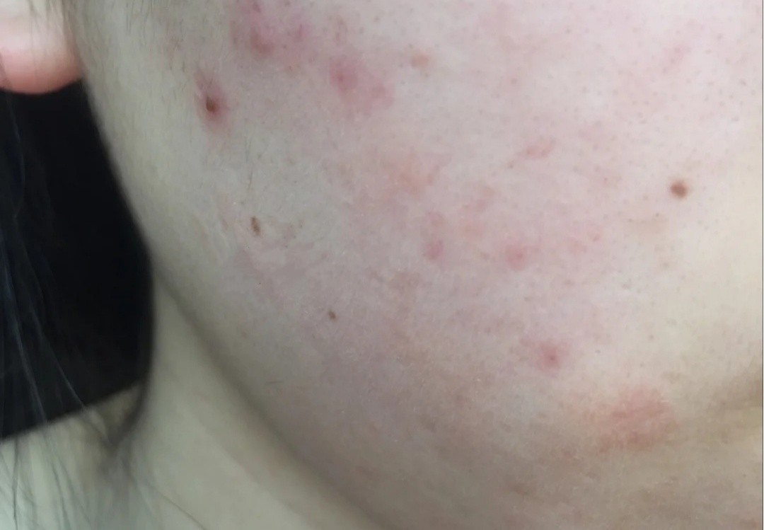 怎么有效简单的祛除痘印的方法,简单有效7大窍门祛除痘印