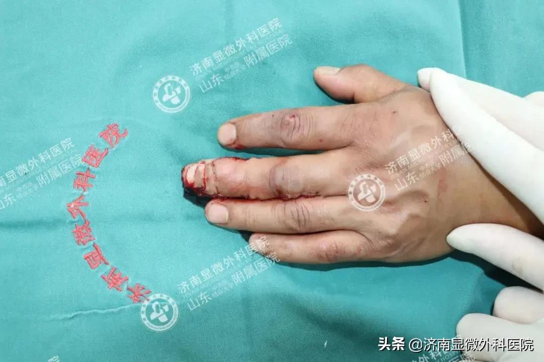 注意！失去一截手指不要灰心，这样做能重新复原它