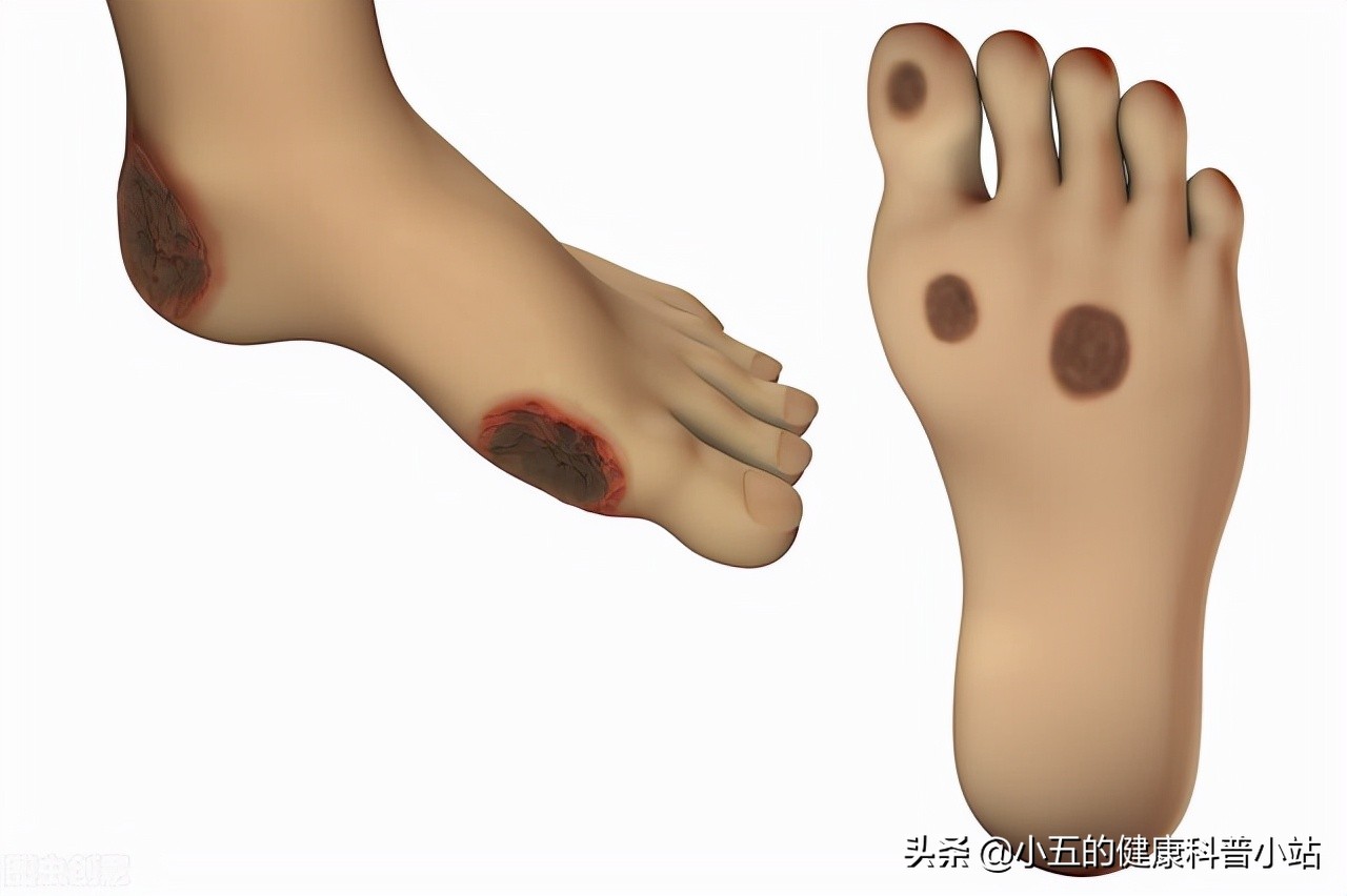 打胰岛素为什么要吃馒头,为什么打胰岛素还需要忌口