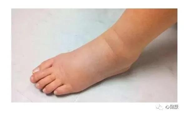 哪种降压药不会引起腿肿,尼莫类降压药容易造成腿肿吗