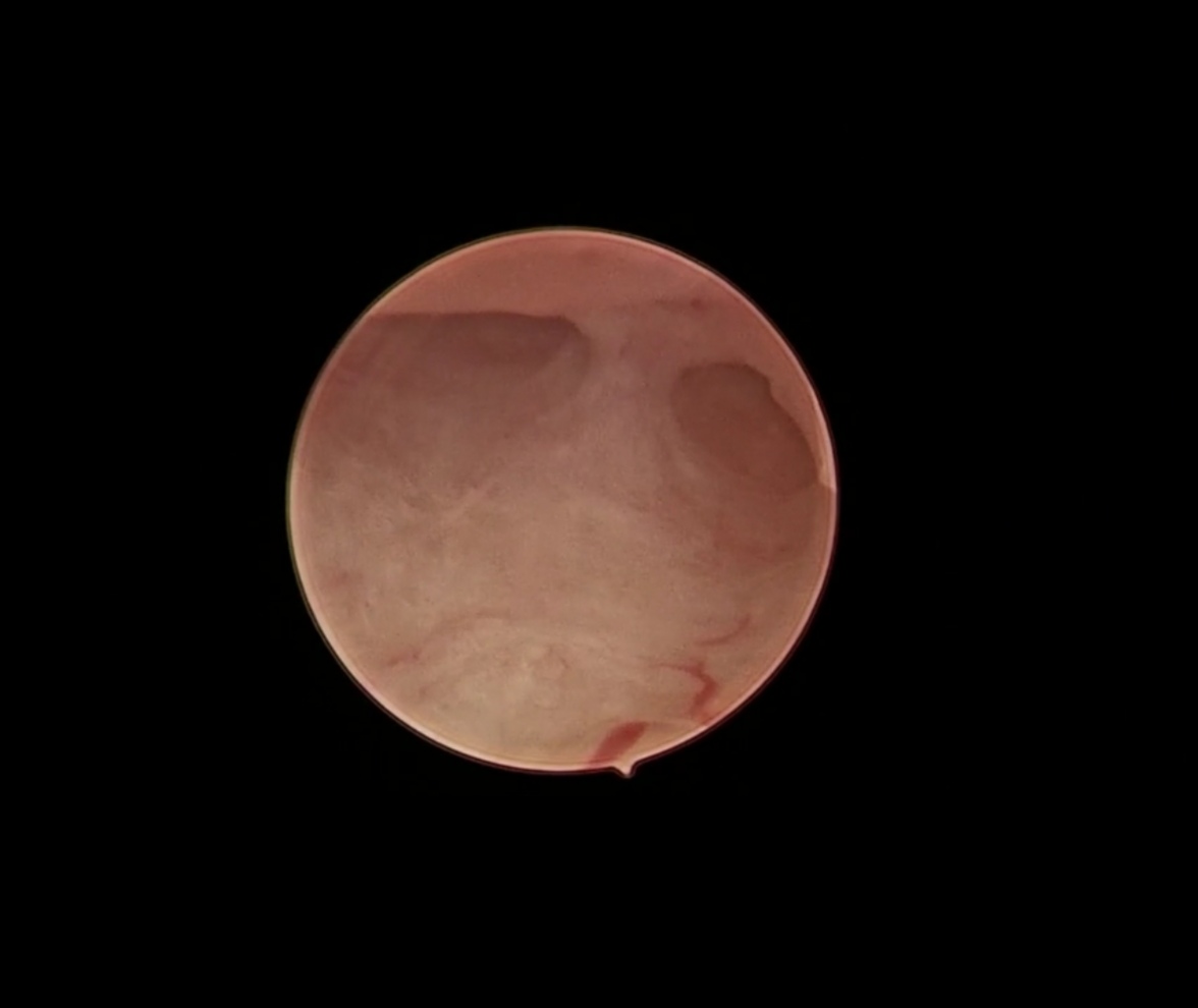 轻微宫腔粘连手术成功案例,轻度宫腔粘连分离术是大手术吗