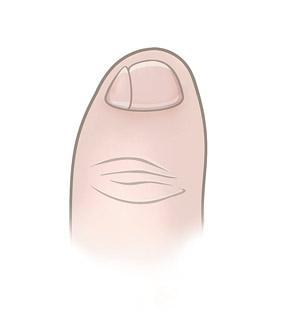 小脚趾甲两瓣是南方人还是北方人,人的小脚趾甲是两瓣是哪里人