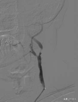 颈动脉狭窄介入治疗,颈动脉狭窄介入手术多少钱