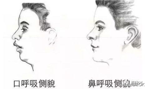 预防乳牙不齐的方法,牙不齐需要乳牙期干预么