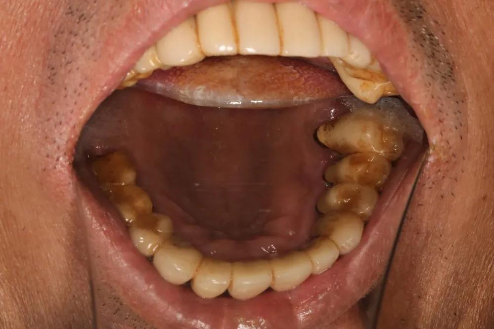 做烤瓷牙如何磨老牙教程,烤瓷牙的正确磨法