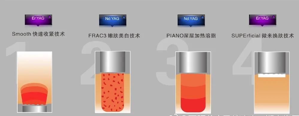 fotona4d效果真的好吗,fotona4d真的有效果吗