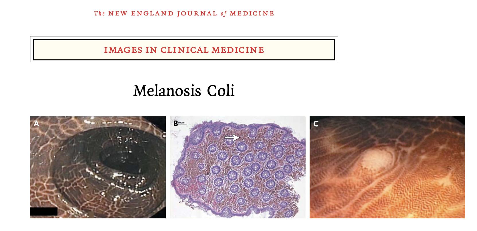 黑心肠,大肠黑变病会致癌吗