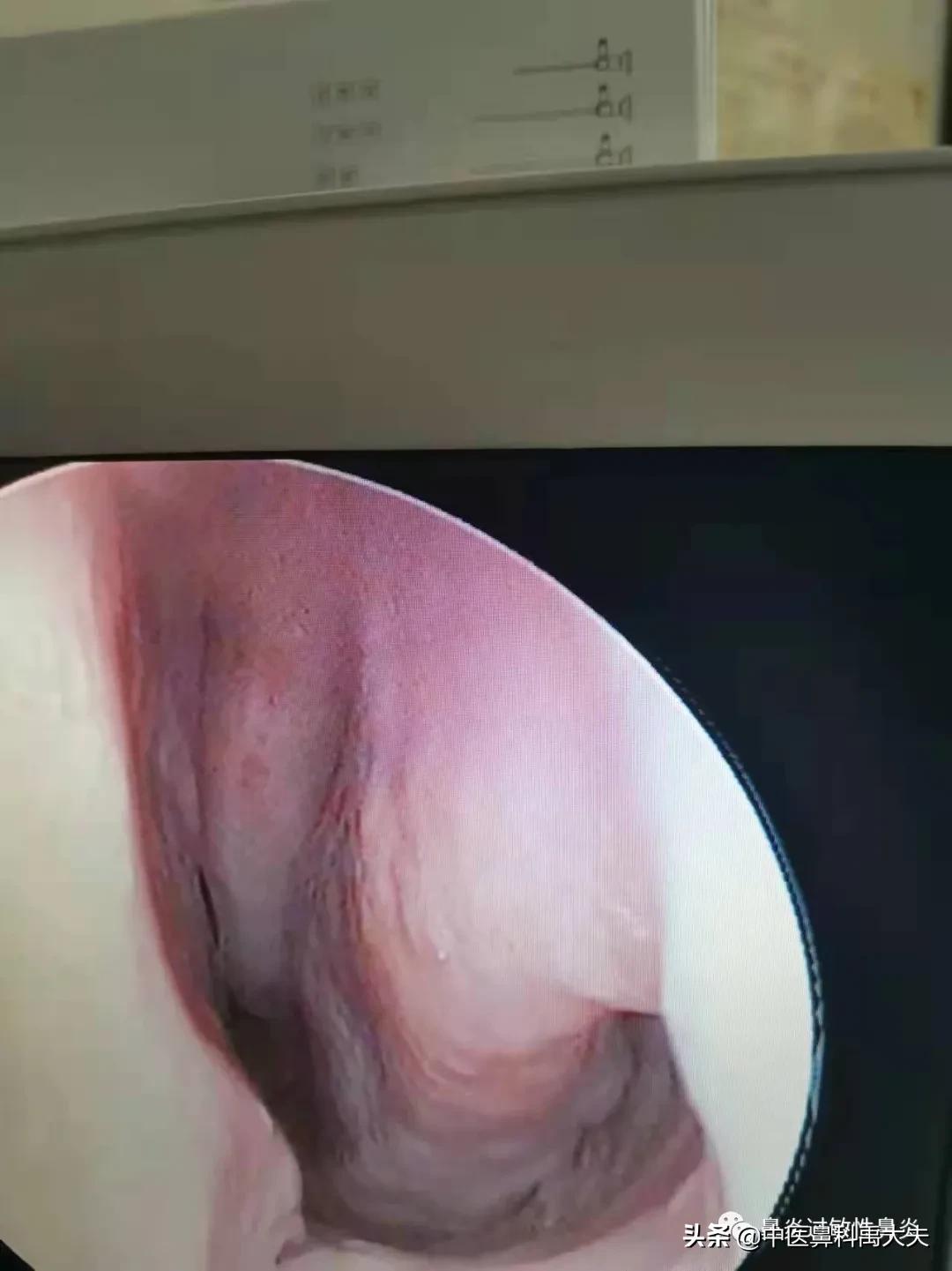 血管运动性鼻炎和过敏性鼻炎症状,鼻炎和过敏性鼻炎症状区别