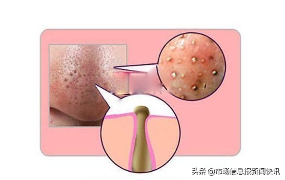 鼻子出油挤出白色的东西怎么解决,鼻子每天都能挤出白色油脂怎么治