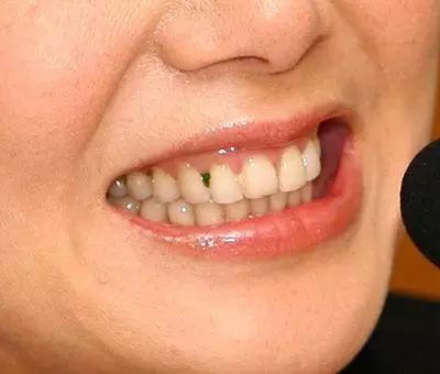 吃东西总塞牙牙缝还恶臭,吃东西老是塞牙缝怎么解决