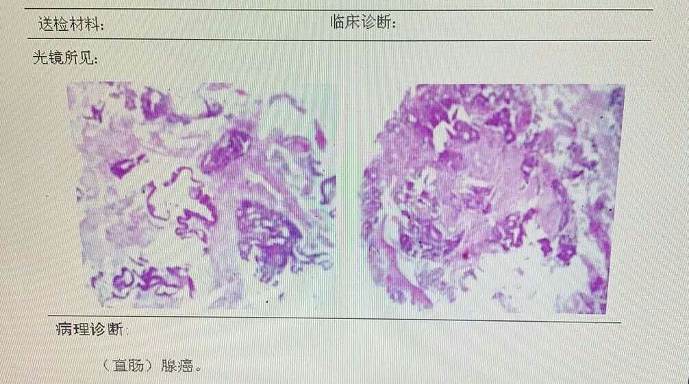 肠息肉发展为肠癌大约多久,肠息肉到肠癌要经过几个阶段