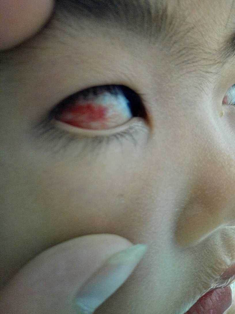 孩子把风油精弄在眼睛里了怎么办,3岁宝宝误食风油精