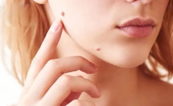 脸上点了痣能洗脸吗应注意什么,这四种痣一定要引起注意了