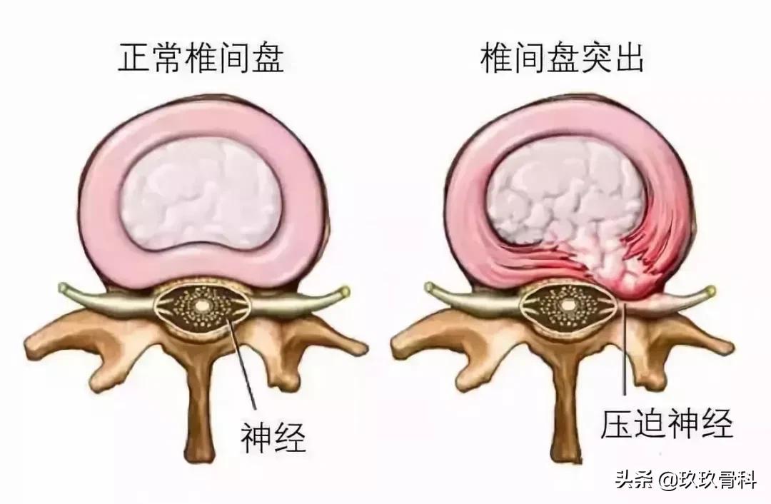 别再被这些传言骗了,腰突必须看的10个信号