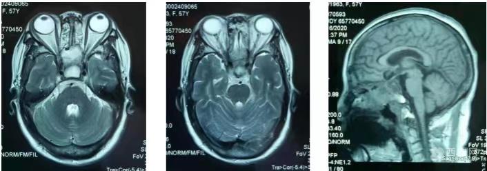 恶性脑瘤切除手术成功率,脑部肿瘤鼻腔微创手术