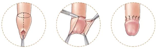 包皮包茎存隐患，生殖健康需关注