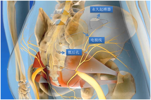 下肢截瘫康复成功案例,全国治疗截瘫最新突破
