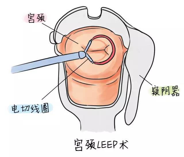 宫颈糜烂影响生育吗影响备孕,宫颈糜烂在备孕上需要注意些什么