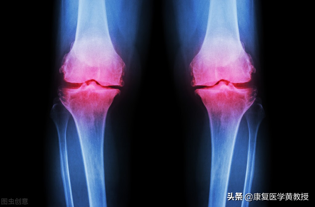 骨刺贴膏药是不是能把骨刺除去,骨刺属于关节炎吗