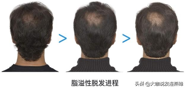 远离脱发的四个误区,脱发前的七大征兆