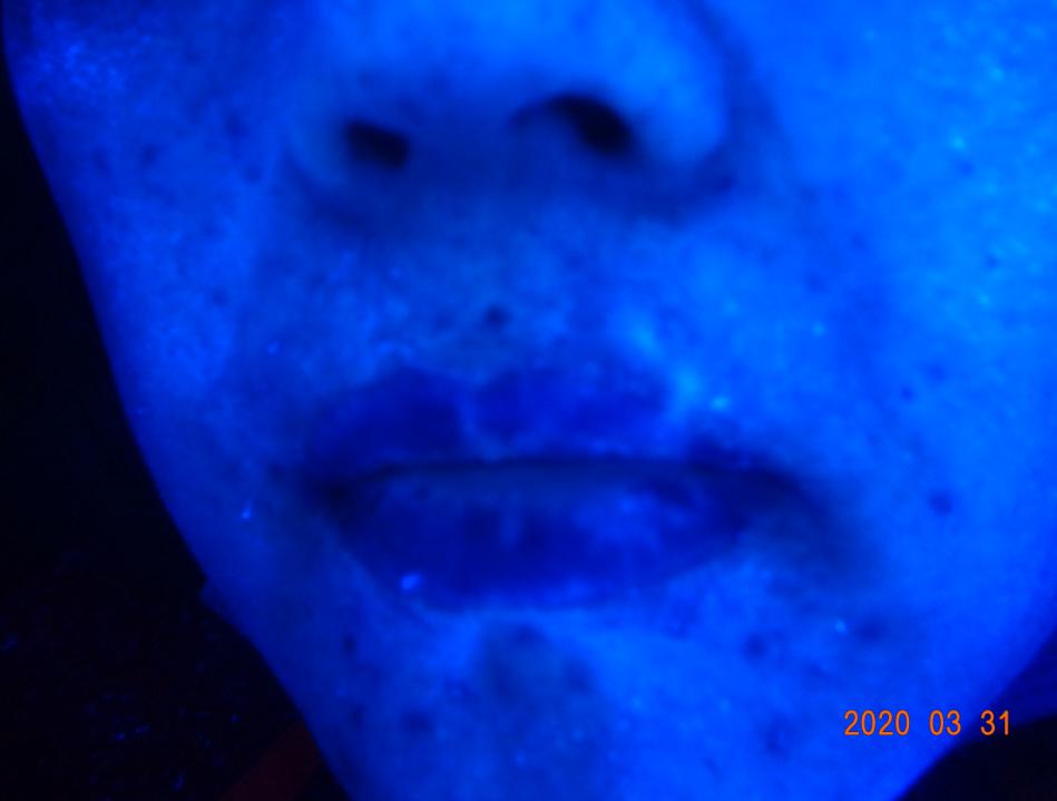 白癜风治愈一百例,白癜风治愈患者分享痊愈经验