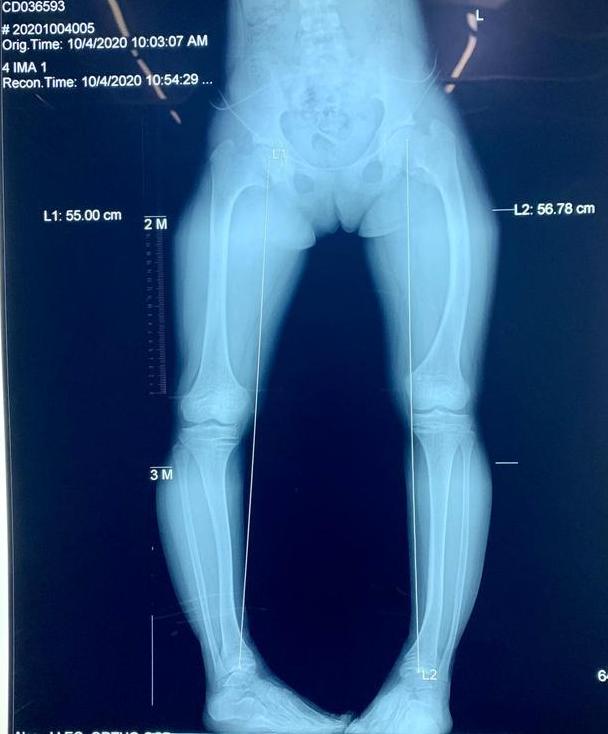 儿童左右腿骨骼发育不一致,2岁男童走路好像腿软总是摔倒