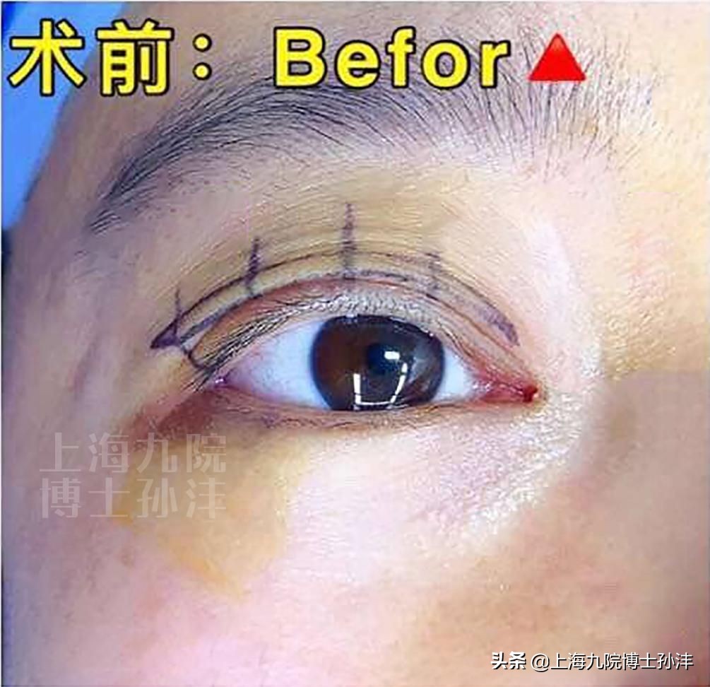 平行双眼皮眼皮薄,多眼皮做双眼皮手术埋线