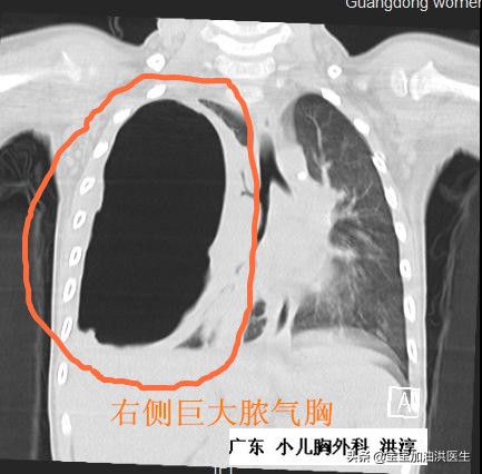 还没生就溢乳是什么导致的,还没生就流虚汗