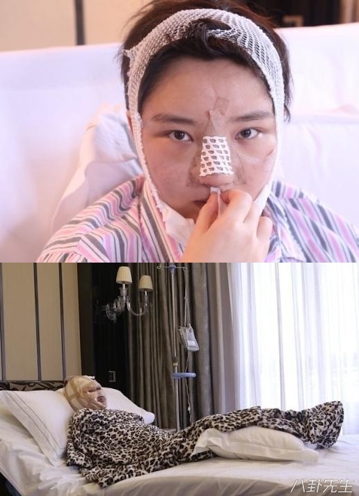 各届超女整容,2015年超女整容失败新闻案例