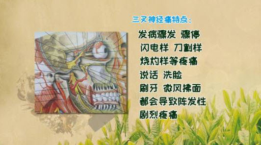 三叉神经痛拍核磁能看出病因吗,面部三叉神经痛的病因