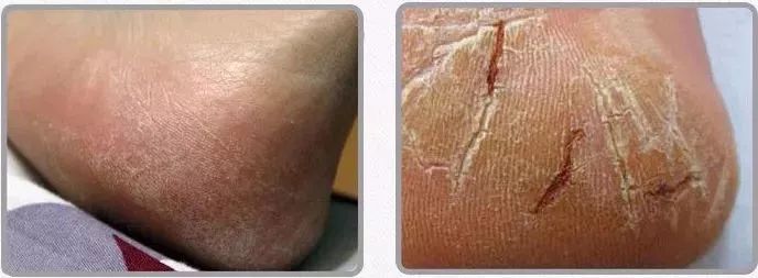 冬天脚跟干裂又起皮怎么办,冬天脚跟干裂起硬皮擦什么保湿好